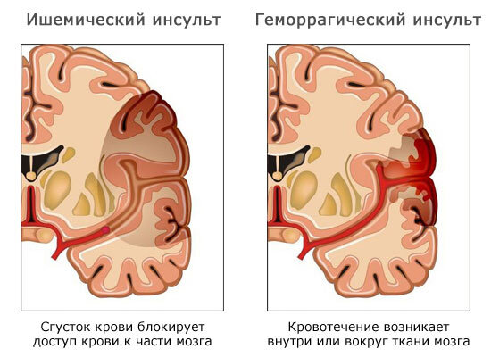 Уход после инсульта в домашних условиях: как ухаживать за больным после инсульта?