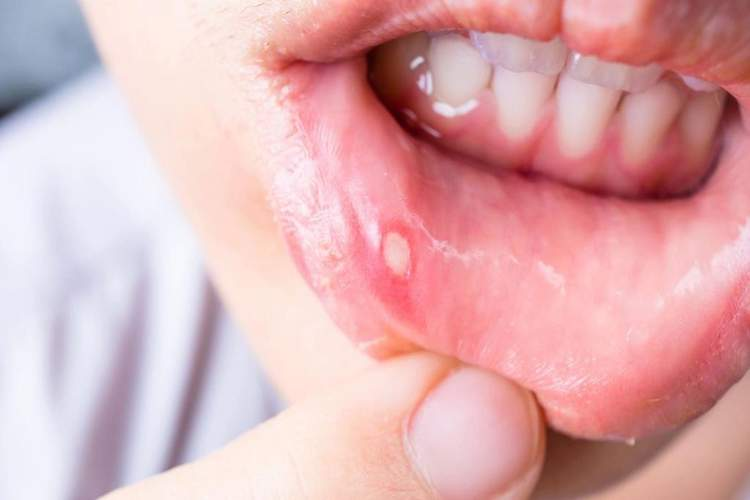 Лечение стоматита во рту у взрослых и детей