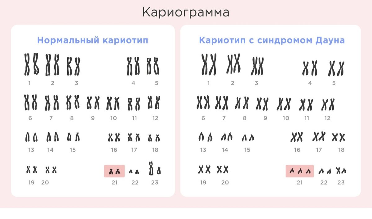 Вот она, маленькая лишняя хромосома, которая так сильно меняет жизни многих людей…