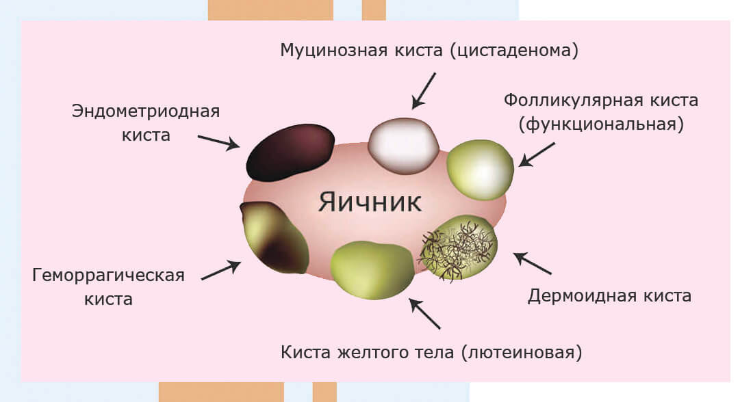 хирургическая стерилизация вазэктомия. что будет если удалить яичники у женщины. что будет если удалить яичники у женщины. лапароскопия в гинекологии киста яичника. что будет если удалить яичники у женщины.