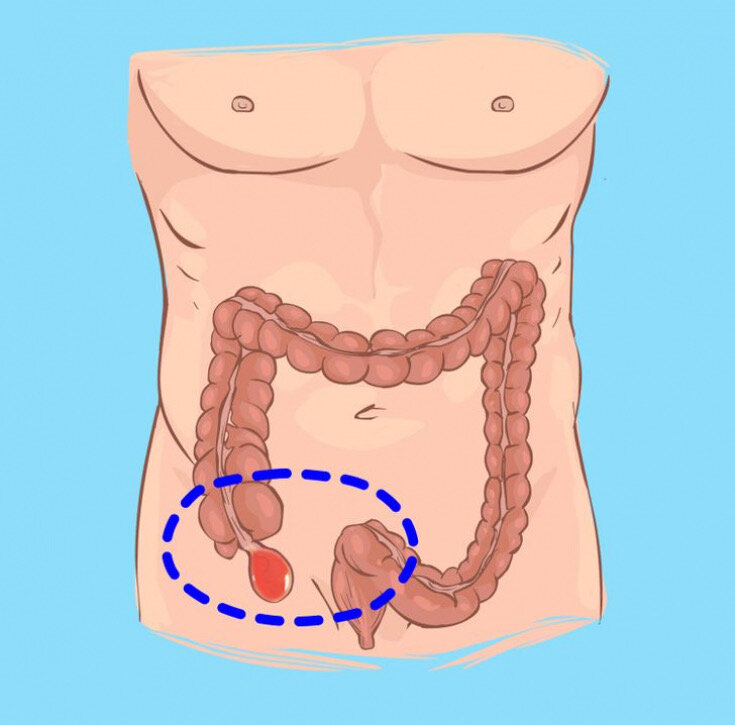 Что такое аппендицит картинки