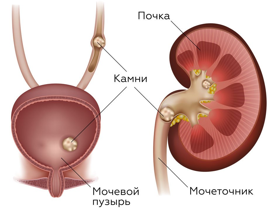Источник фото: https://clinsev.ru/poleznaya_informaciya/stati/mochekamennaya_bolezn/