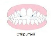 Открытый – отсутствие смыкания или во фронтальной, или в боковой области, что приводит к проблемам с глотанием,
жеванием, дикцией, а также к появлению частого кариеса
и постоянному пересыханию слизистой;