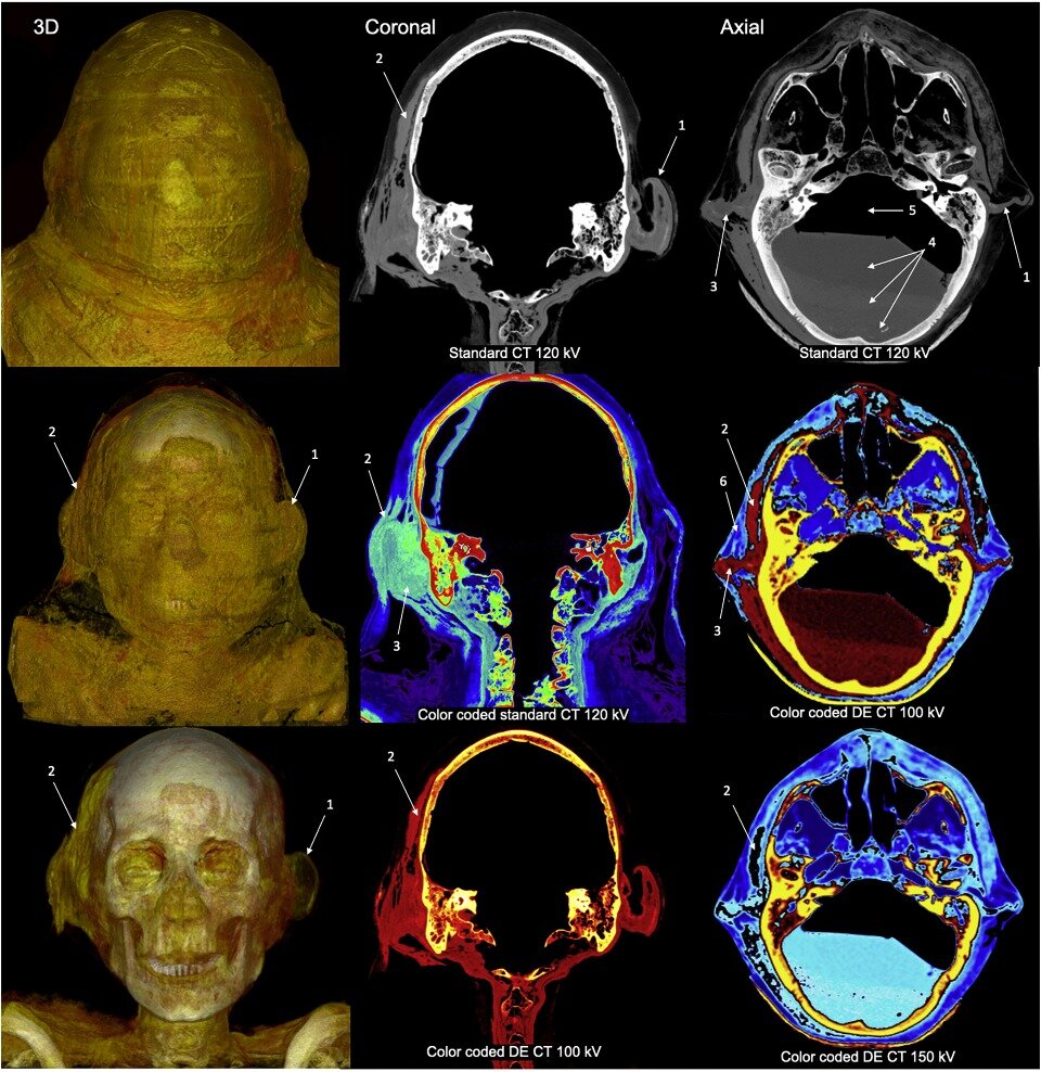   R. Sokiranski et al. / European Annals of Otorhinolaryngology, Head and Neck Diseases, 2023