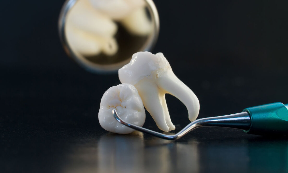 Современная стоматология имеет в своем арсенале множество методов, позволяющих сохранить даже проблемные зубы. Однако в некоторых случаях удаления все-таки не избежать.