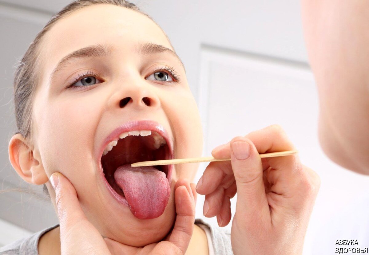 Что такое ангина и как ее лечить?