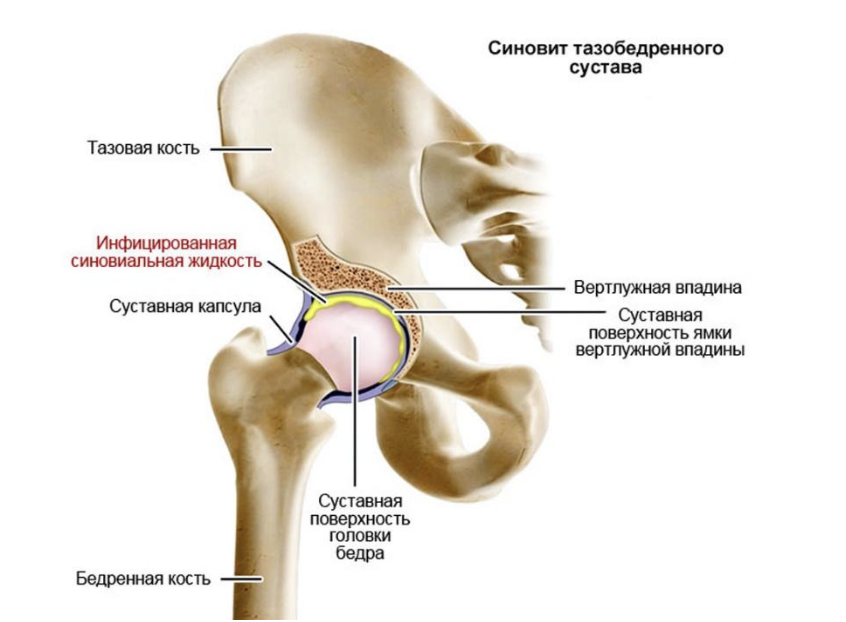 Вертлужная впадина тазобедренного сустава. Синовит тазобедренного сустава сустава. Двусторонний синовит тазобедренного сустава. Анатомия вертлужной впадины тазобедренного сустава.