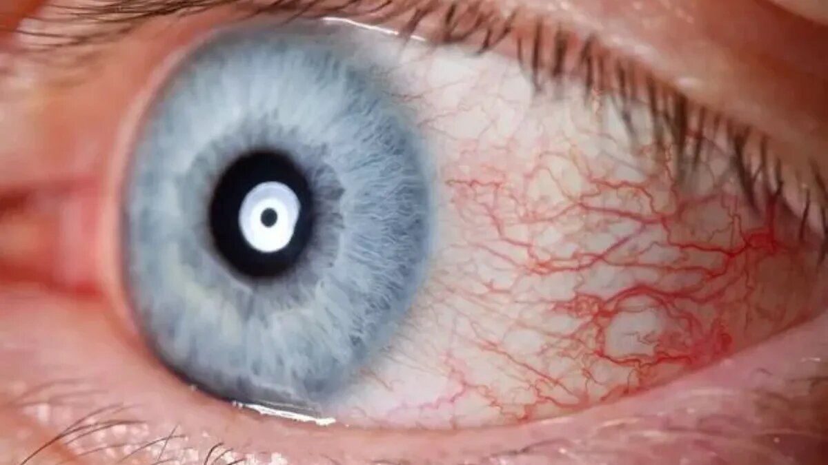 Неожиданный безболезненный ранний симптом инсульта, который люди обычно ...