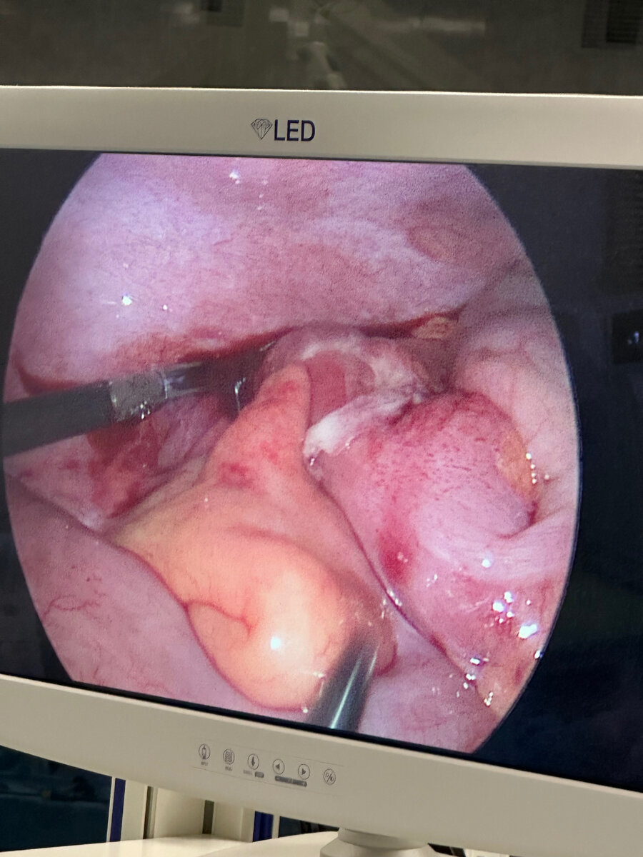 На фотографии образовались спайки вокруг аппендицита, сам аппендицит спаялся верхушкой с брюшной стенкой. Была проведена лапроскопия, так как послеоперационный период восстановления намного быстрее.