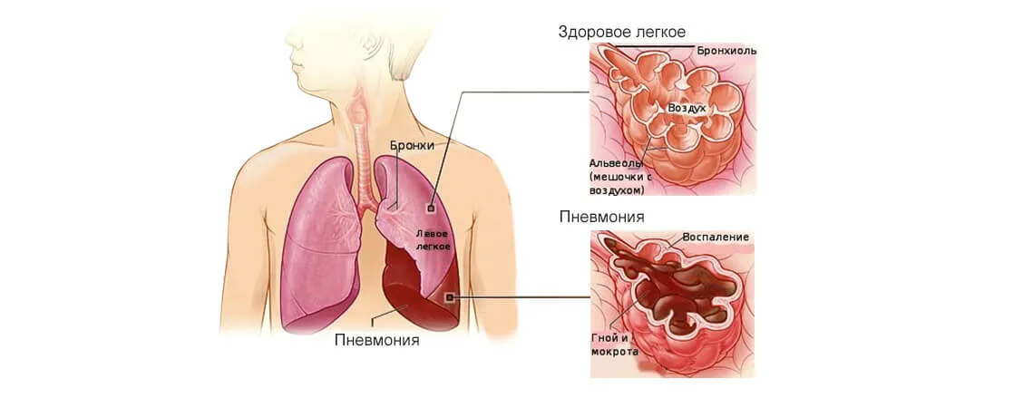 Заболевания дыхательной системы пневмония. Заболевание легких пневмония. Пневмония это острое инфекционное заболевание. Заразные заболевания легких