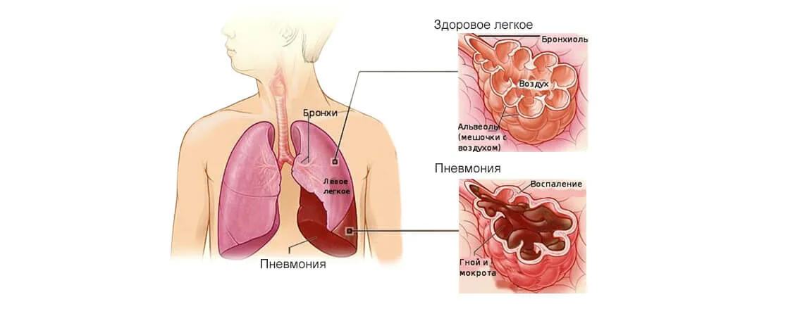 Воздух в бронхах. Заболевания дыхательной системы пневмония. Нормальные легкие и пневмония.