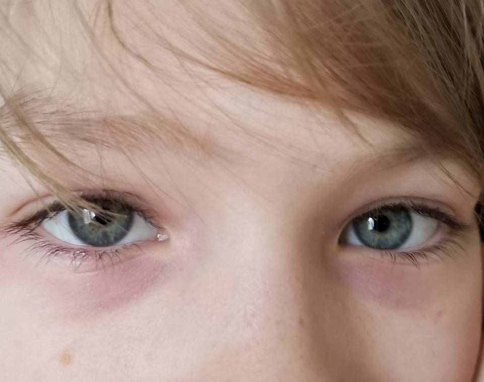 Является ли синева под глазами у ребенка нормой?