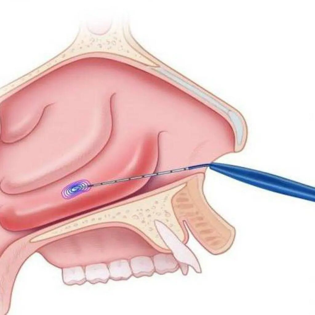 Радиоволновая вазотомия