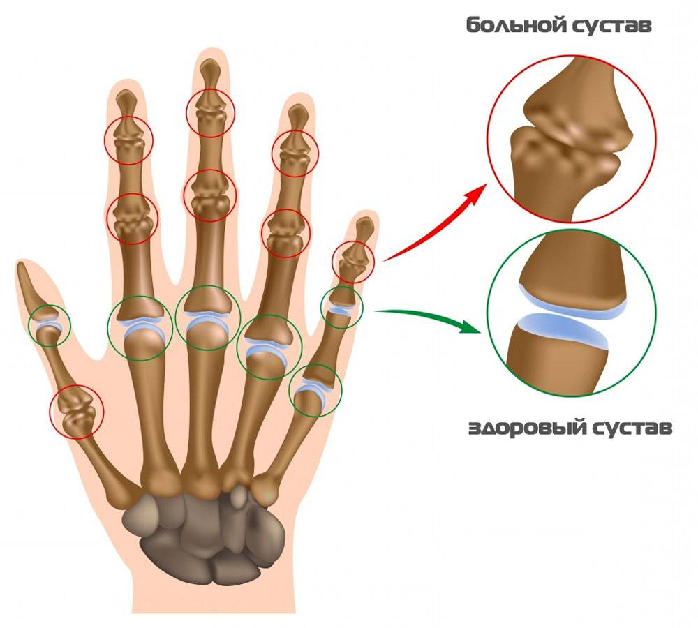 Почему болит кость пальца. Ревматоидный артрит кисти. Артрит межфаланговых суставов кисти. Артроз межфаланговых суставов. Суставы пальцев рук анатомия.
