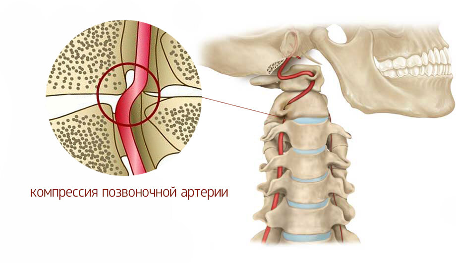 Синдром позвоночной артерии - Vertebra