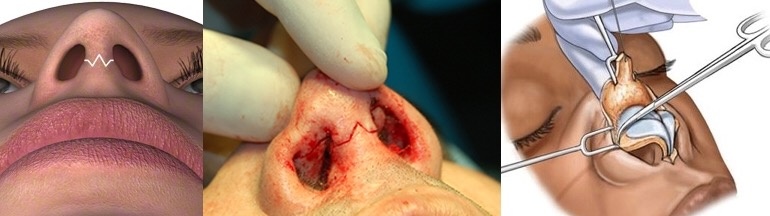 липосакция, пластика живота, ринопластика, пластика носа, пластический хирург, септопластика, изменить нос, маммопластика, пластический хирург, здоровье, красота, пластика груди, увеличение груди, москва