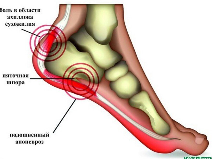 От чего может болеть правая пятка. Болит свод стопы с внешней стороны. Болит между пяткой и ступней. Болит стопа посередине.