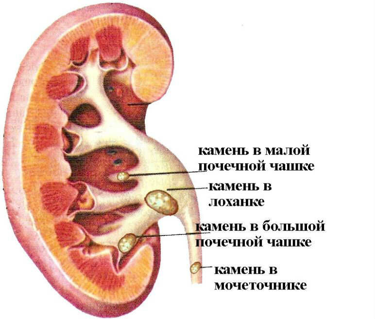 Лечение камней в мочевыделительной системе. Урологическое отделение "ЕвроМед клиники".