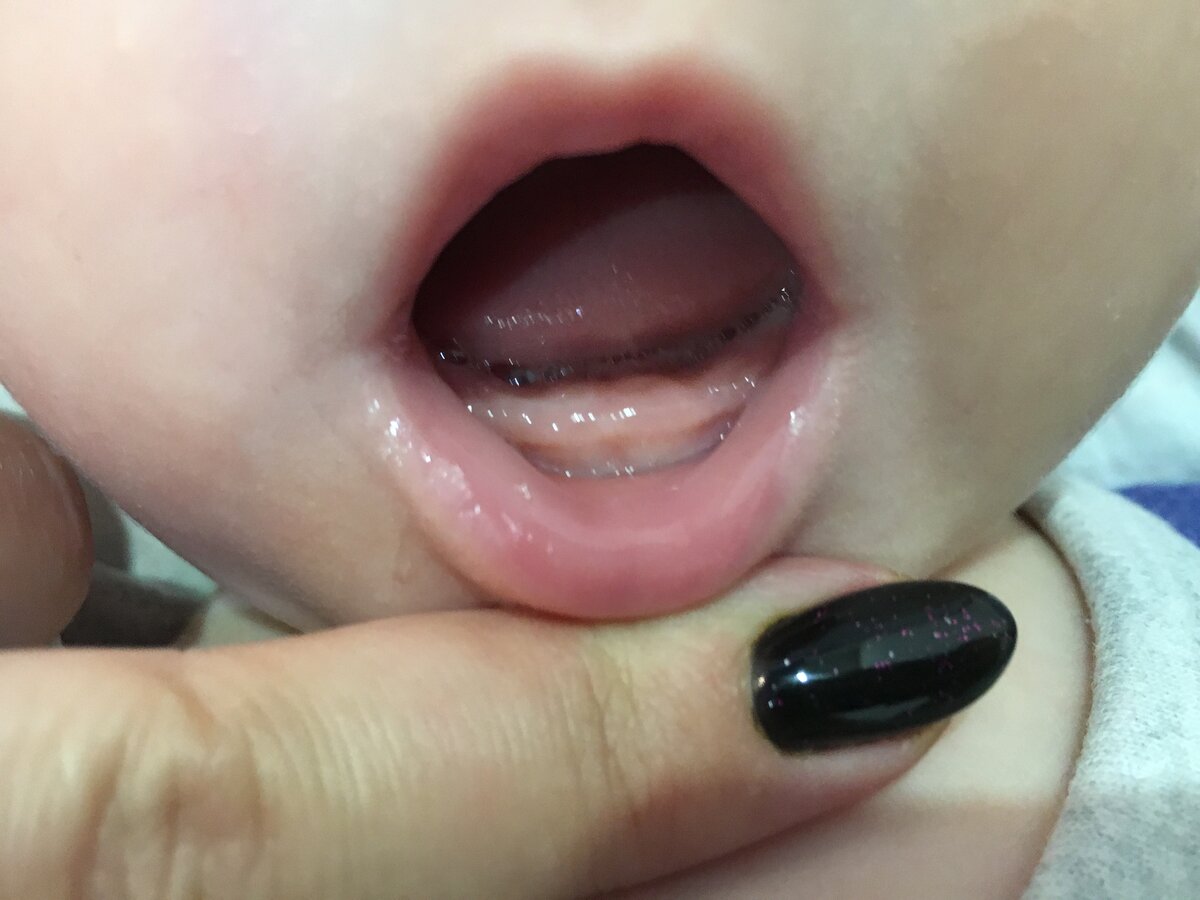 Почему у ребенка плохие гнилые зубы: 13 причин и спасение