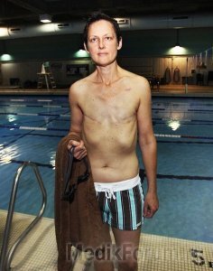 Прошедшей через двойную мастэктомию женщине не разрешали плавать в бассейне без верха купальника. И это несмотря на то, что ношение тесного купальника вызывает у нее сильную боль, а скрывать бюстгальтеру уже нечего.