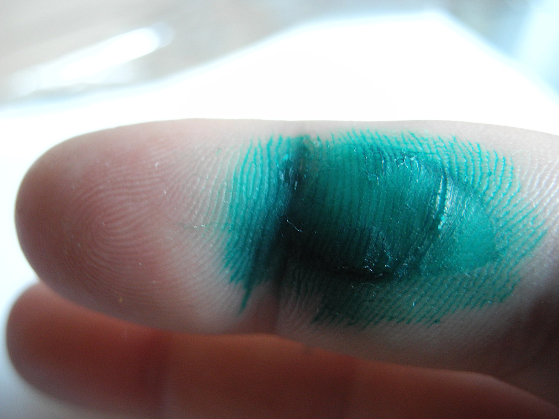 Фото из интернета, но очень похоже на мой палец, но уже после того, как заживать начал.