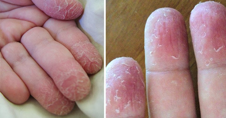 Трескается кожа на пальцах рук и ног: почему трескается у взрослых и чем это лечить