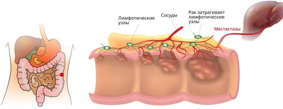 Метастазирование рака толстого кишечника