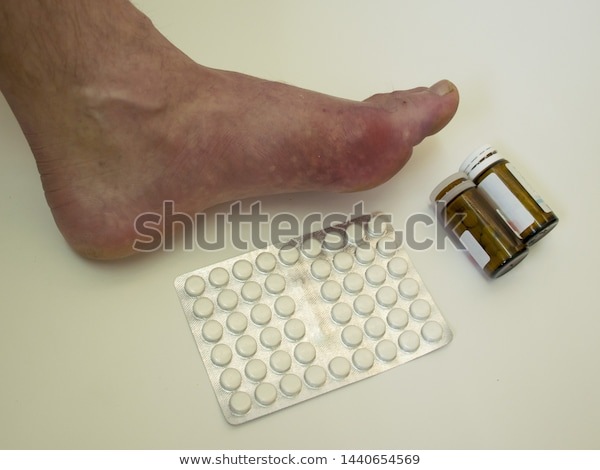 https://www.shutterstock.com/image-photo/foot-disease-rheumatism-gout-red-leg-1440654569