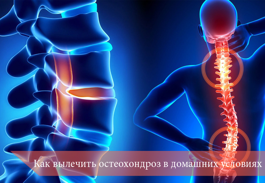 Лечение остеохондроза в домашних условиях | Клиника доктора Шишонина