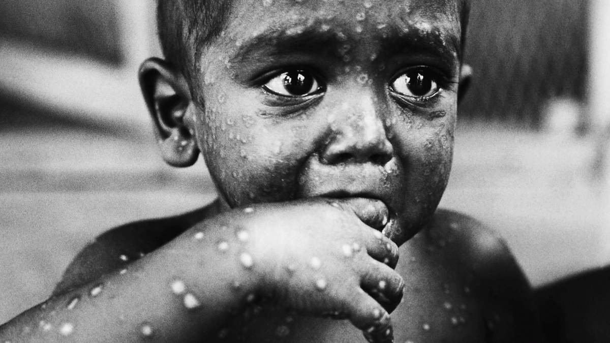 РЕбенок, больной оспой, Африка, 20 век.
