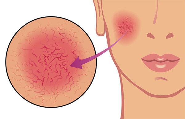 Что такое купероз лица и как от него избавиться?