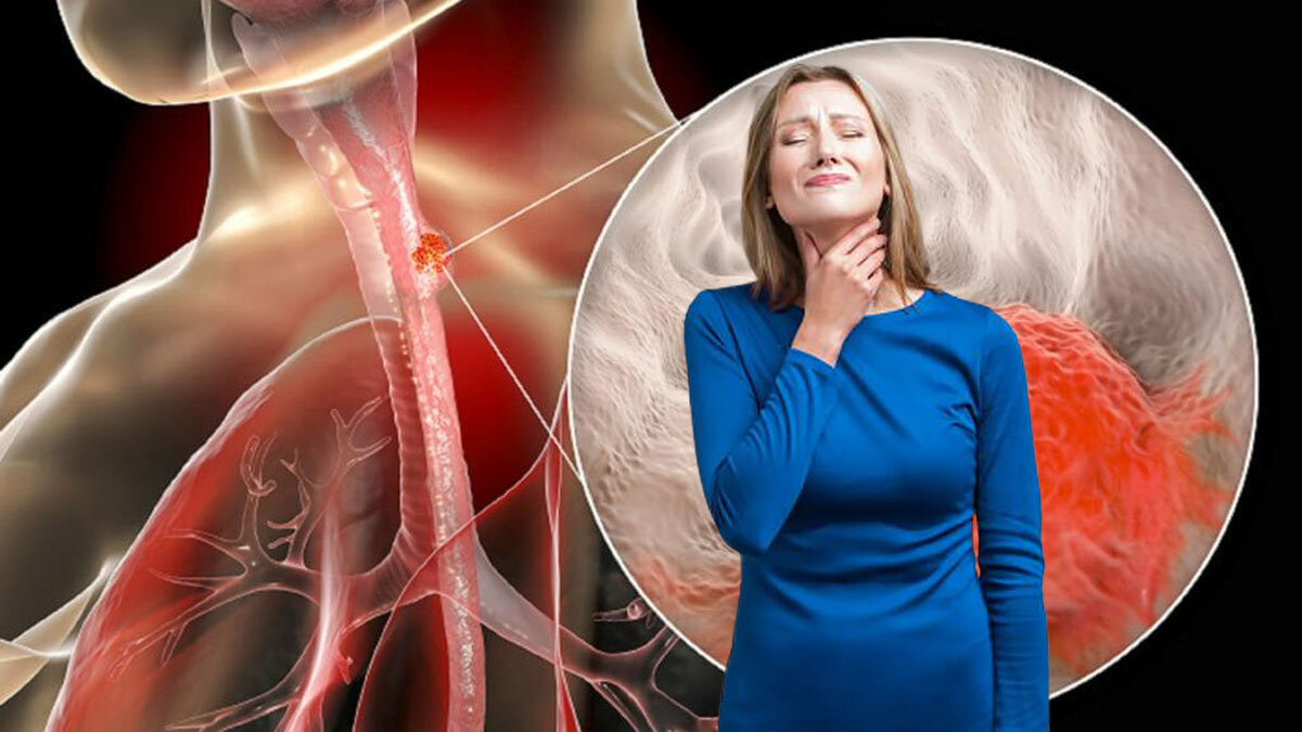 Новая неизвестная болезнь: еда застревает в горле. Что делать?