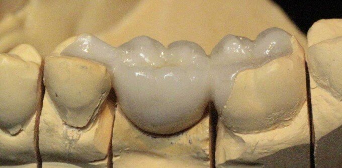 Несъемные зубные протезы: какие они бывают? | Стоматология ROOTT | Дзен