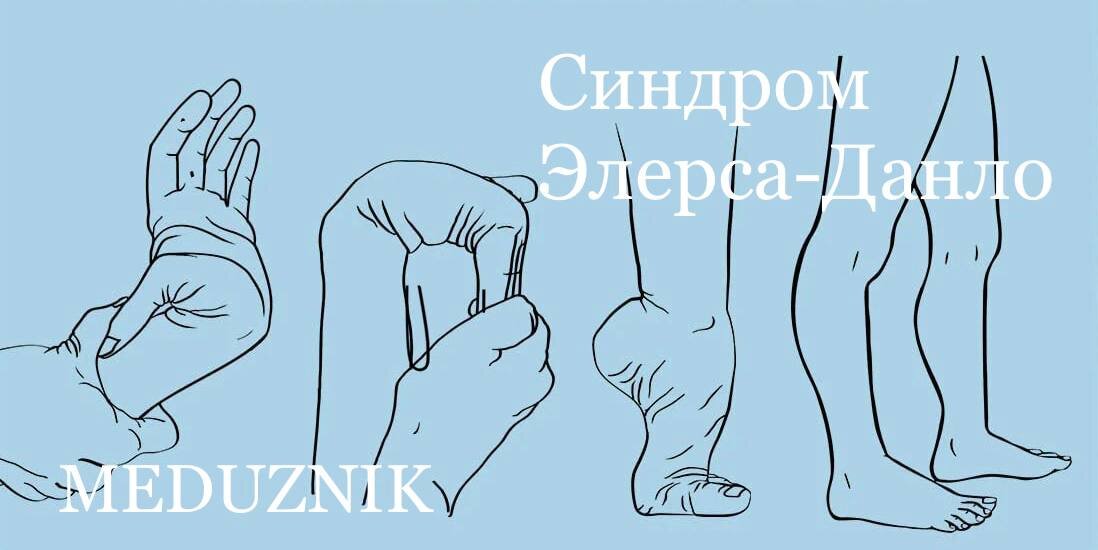 Гипермобильность суставов, чрезмерная растяжимость кожи, плохое заживление ран с образованием атрофических рубцов — основные характерные черты синдрома Элерса-Данло. Основой патогенетических процессов являются дегенеративные изменения соединительной ткани, которые вызываются нарушением биосинтеза коллагена. Рассмотрены наиболее распространенные формы синдрома Элерса-Данло и критерии постановки диагноза.