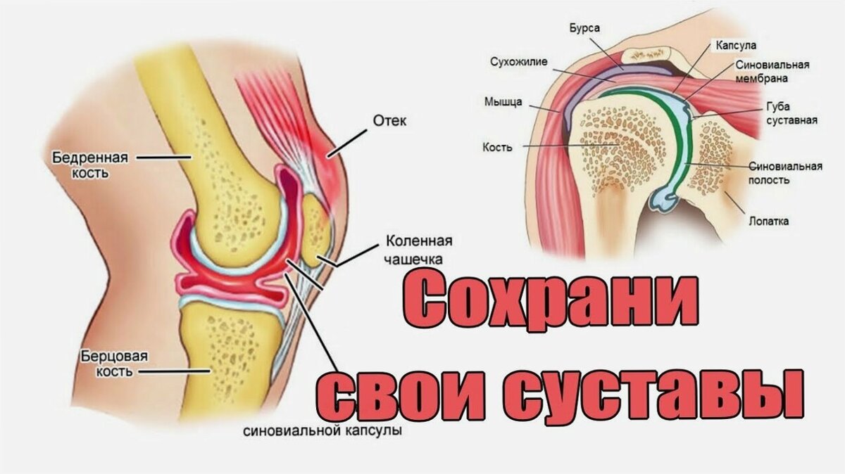 ПРИВЫЧНЫЙ ВЫВИХ НАДКОЛЕННИКА КОЛЕННОГО СУСТАВА