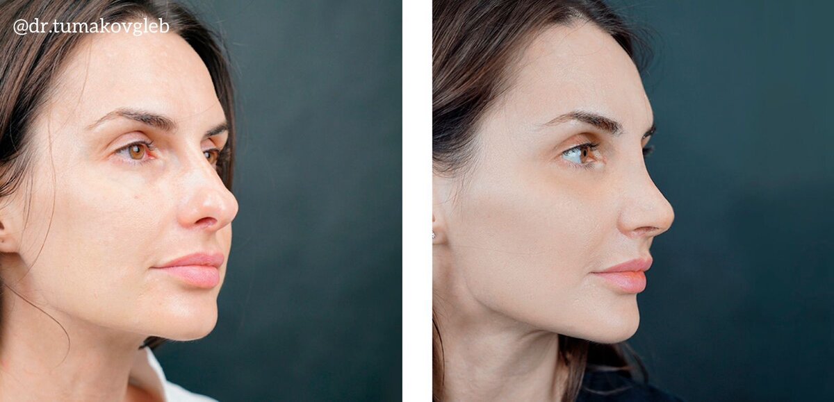 Результат риносептопластики спустя месяц после операции.