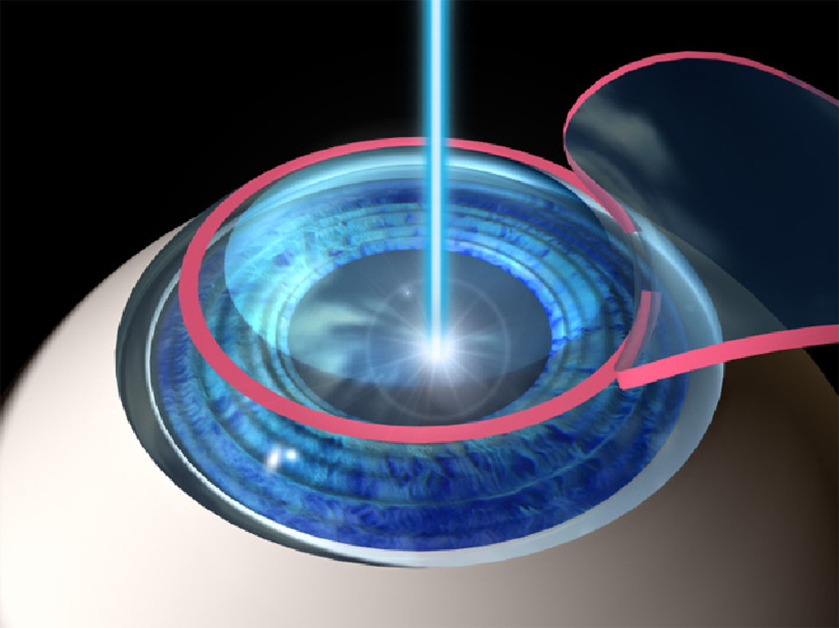 Лазерная коррекция зрения 2024. Фемто ласик. Лазерная операция ласик. Лазерная рефракционная кератопластика по технологии LASIK.
