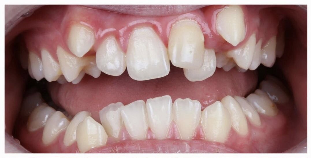 Исходная ситуация до ортодонтического лечения 