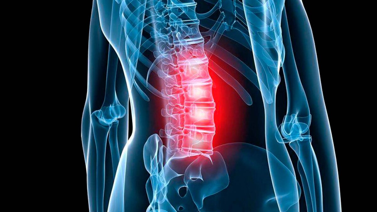 Остеохондроз позвоночника. Остеохондроз поясничного отдела позвоночника. Остеохондроз пояснично крестовый отдел позвоночника. Остеохондроз поясничного отдела крестцового отдела. Остеохондроз поясничного отдела позвоночника синдромы.
