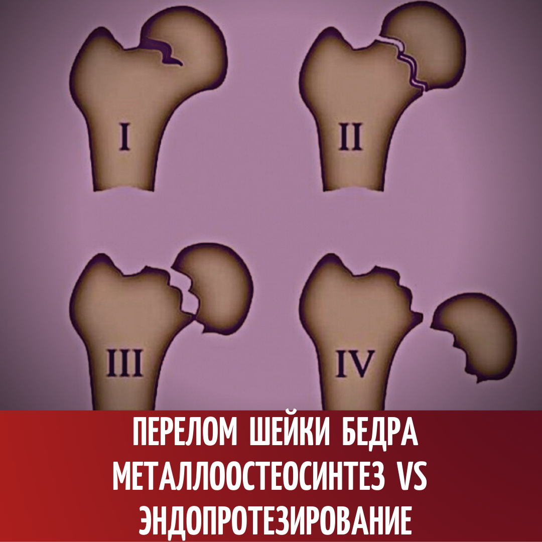 Перелом шейки бедра. Металоостиосинтез VS эндопротезирование | Реабилитация  ONLINE | Дзен