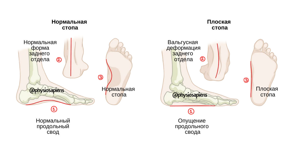 Почему стопа