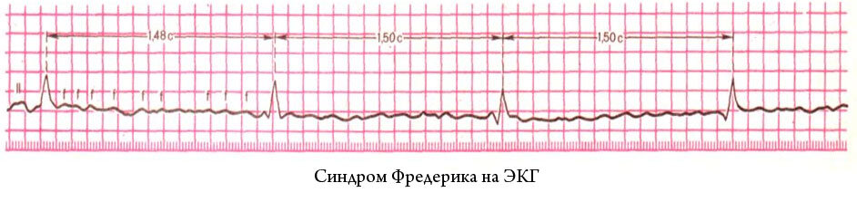 При фибрилляции предсердий ритм всегда нерегулярный, беспорядочный, но есть единственное исключение - синдром Фредерика, когда ритм становится регулярным, правильным 