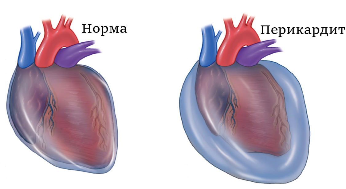Кровь в перикардиальной полости. Гемоперикард с тампонадой сердца. Гидроперикард тампонада сердца.