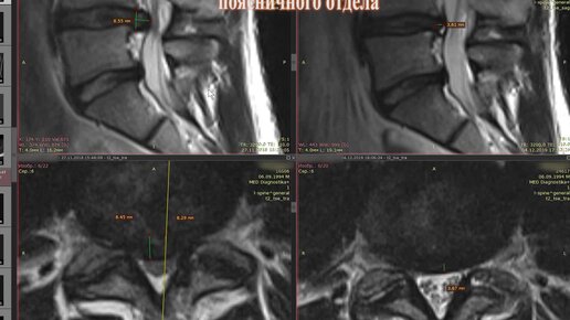Дорзальная парамедиальная грыжа диска. Парамедианная грыжа. Выпадение грыжи 7 мм а поясничном. Парамедиальная грыжа диска \.