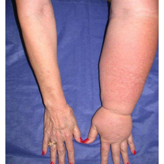 Пациентка с лимфостазом левой руки