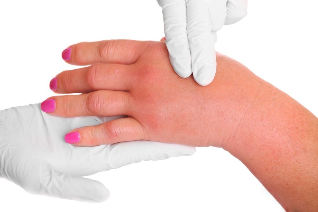 Симптомы артроза пальцев и кистей рук