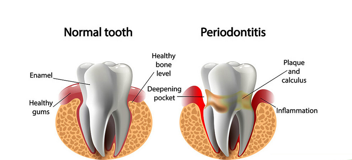 Периодонтит у детей: Лечение периодонтита в СПб - Евромед Дентал