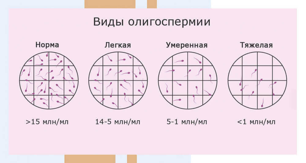 Азооспермия. Почему отсутствуют сперматозоиды? Лечение