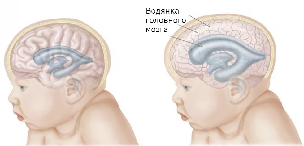 Увеличение желудочков головного