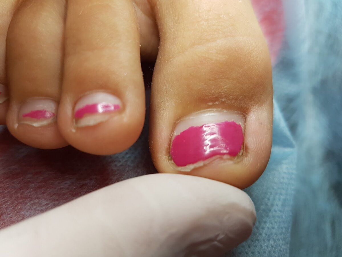 Ногти на ногах. Неправильно подстриг ноготь. Женские ногти на ногах. Ногти на ногах под корень. Нога на ногу.